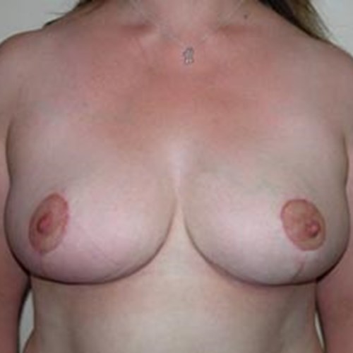 Breast Reduction Post4