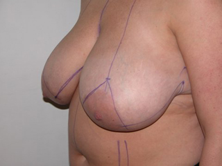 Breast Reduction Pre 3