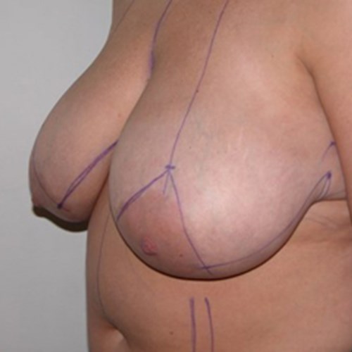 Breast Reduction Pre 3