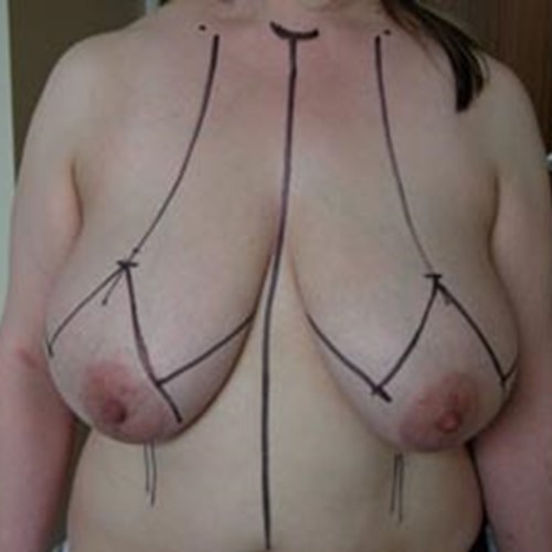 Breast Reduction Pre 4