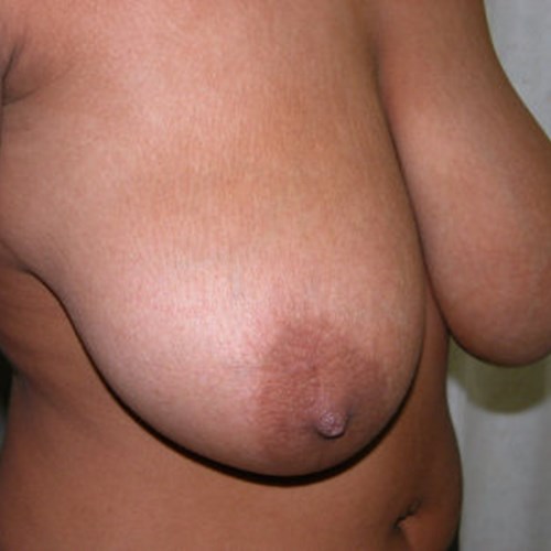 Breast Reduction Pre 1