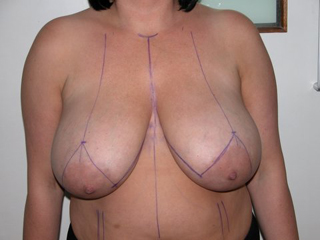 Breast Reduction Pre 2