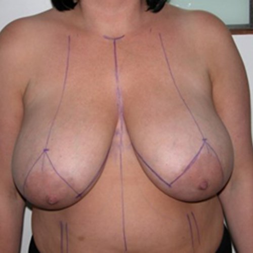 Breast Reduction Pre 2