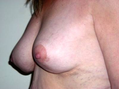 Breast Surgery Post 2