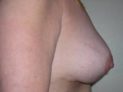 Breast Surgery Post 3