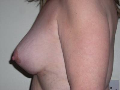 Breast Surgery Post 4