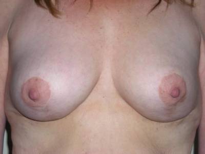 Breast Surgery Post 5