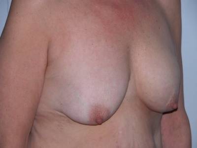 Breast Surgery Pre 3