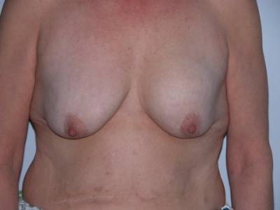 Breast Surgery Pre 4