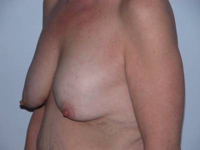 Breast Surgery Pre 6