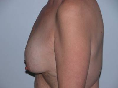 Breast Surgery Pre 7