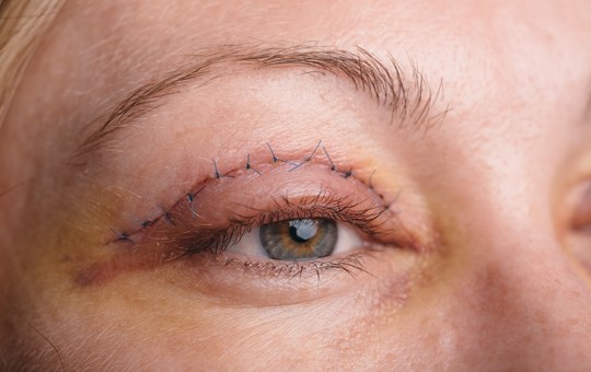 Blepharoplasty - Eyelid Rejuvenation