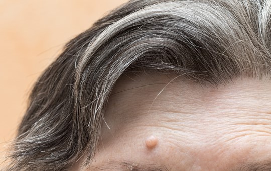 Skin Lumps and Cysts