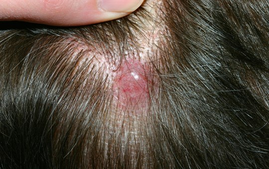 Removal Of Skin Cancer On Scalp لم يسبق له مثيل الصور Tier3 Xyz