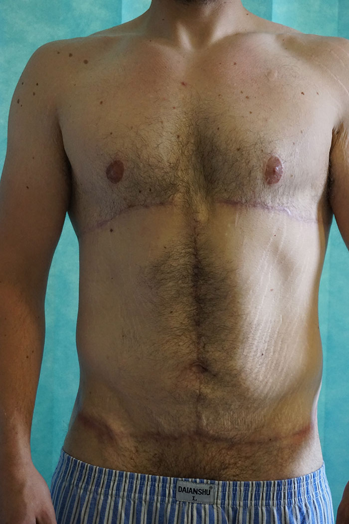 Post op - Belt lipectomy, FDL Abdominoplasty and Breast correction.jpg