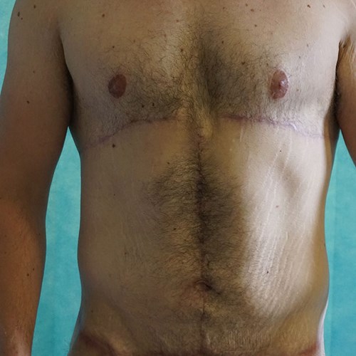 Post op - Belt lipectomy, FDL Abdominoplasty and Breast correction.jpg
