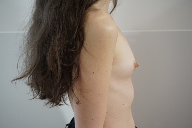 Breast Augmentation - Pre 4.jpg