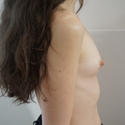 Breast Augmentation - Pre 4.jpg