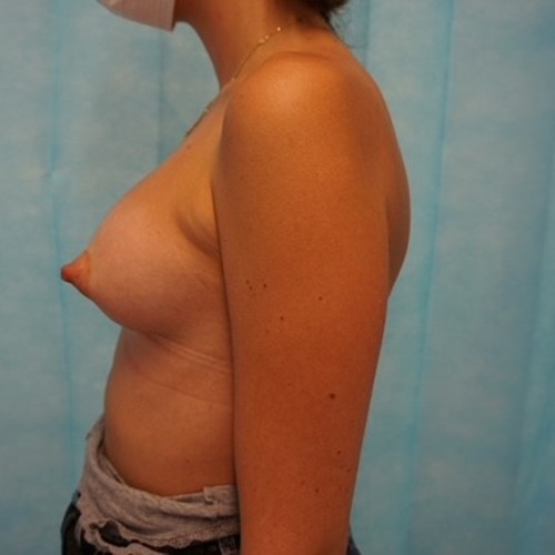 Breast Augmentation - Post 6.jpg