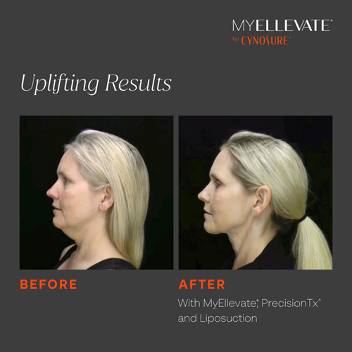 Uplifting Results