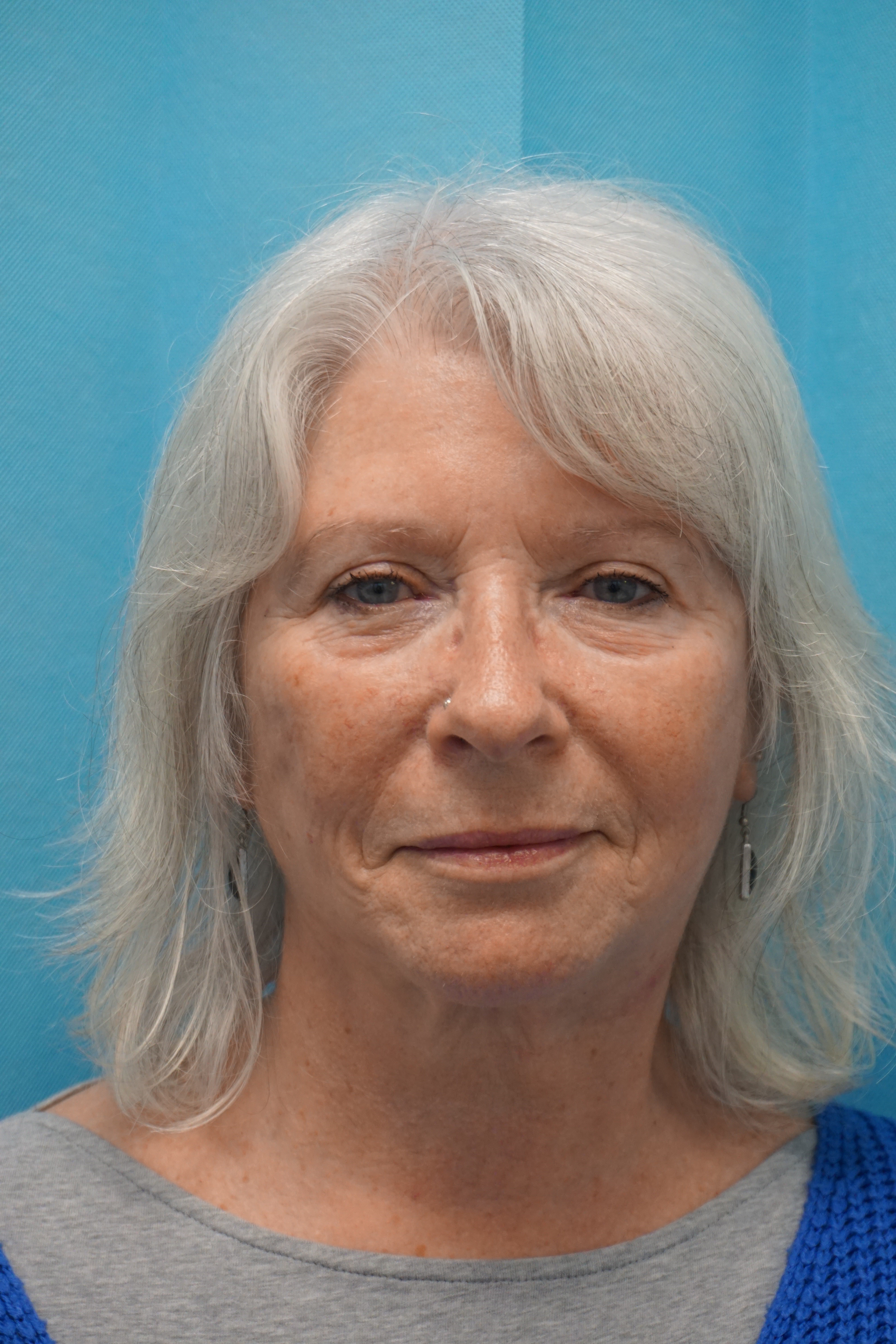 Natural Looks Post Op1.jpg