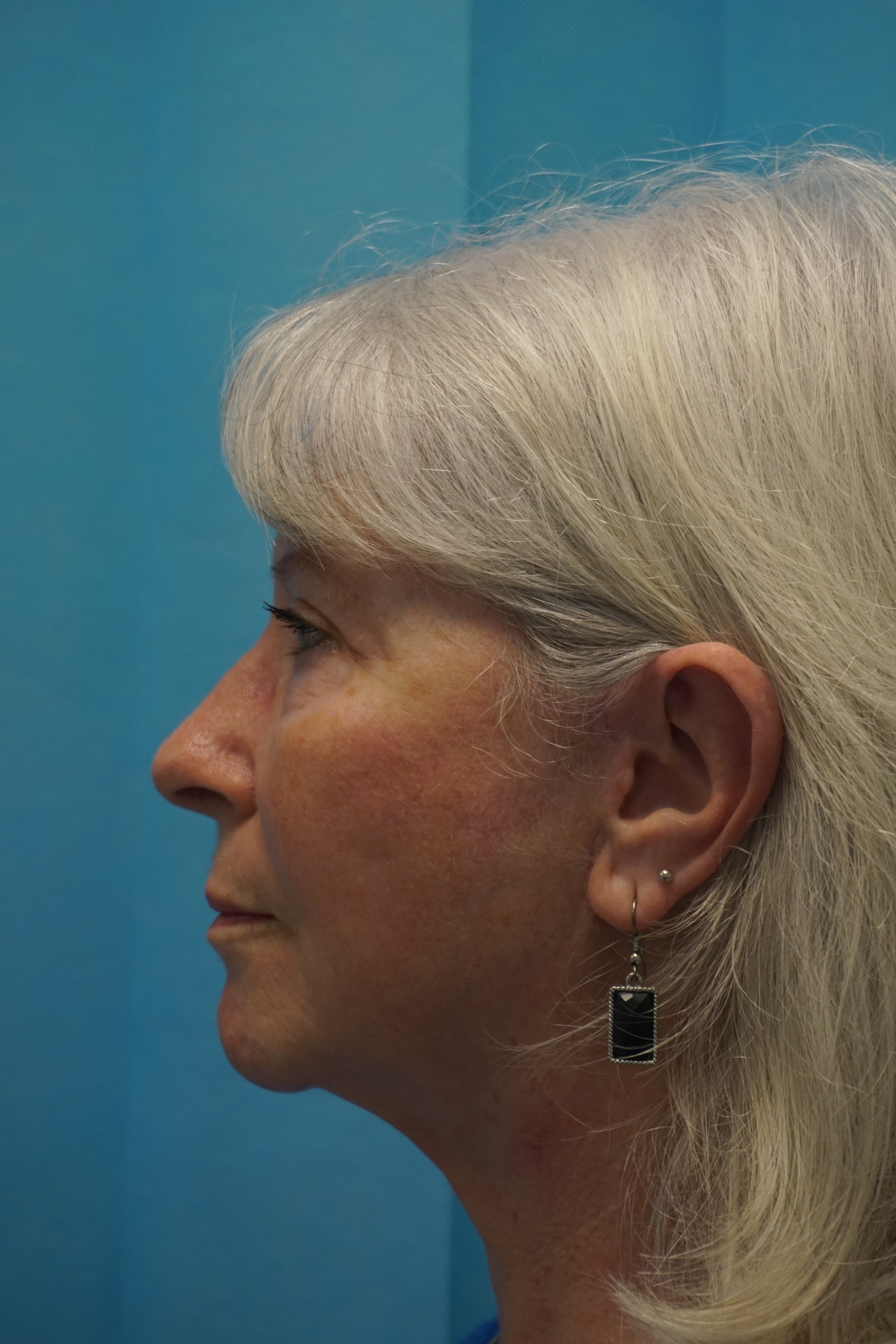 Natural Looks Post Op2.jpg