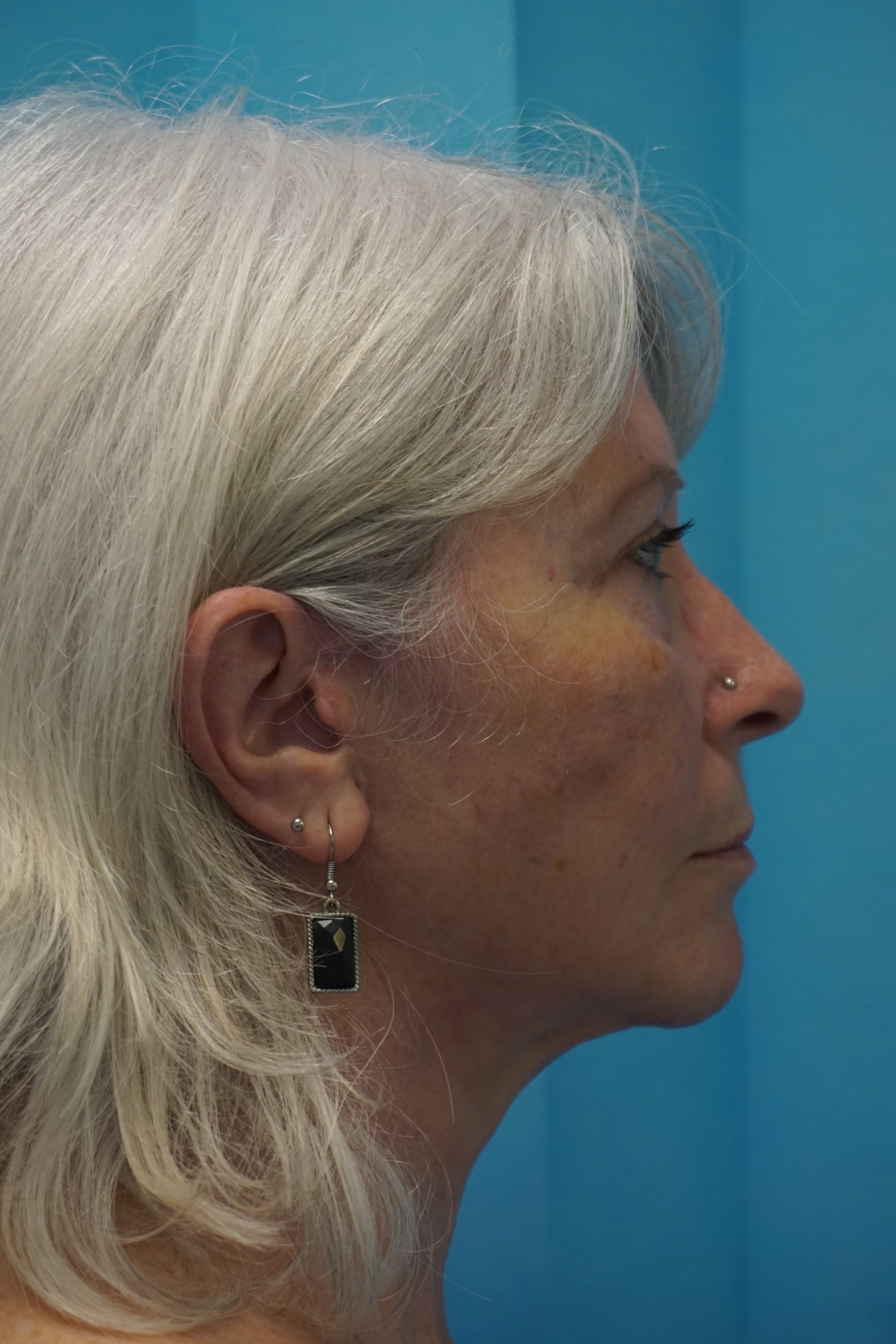 Natural Looks Post Op3.jpg