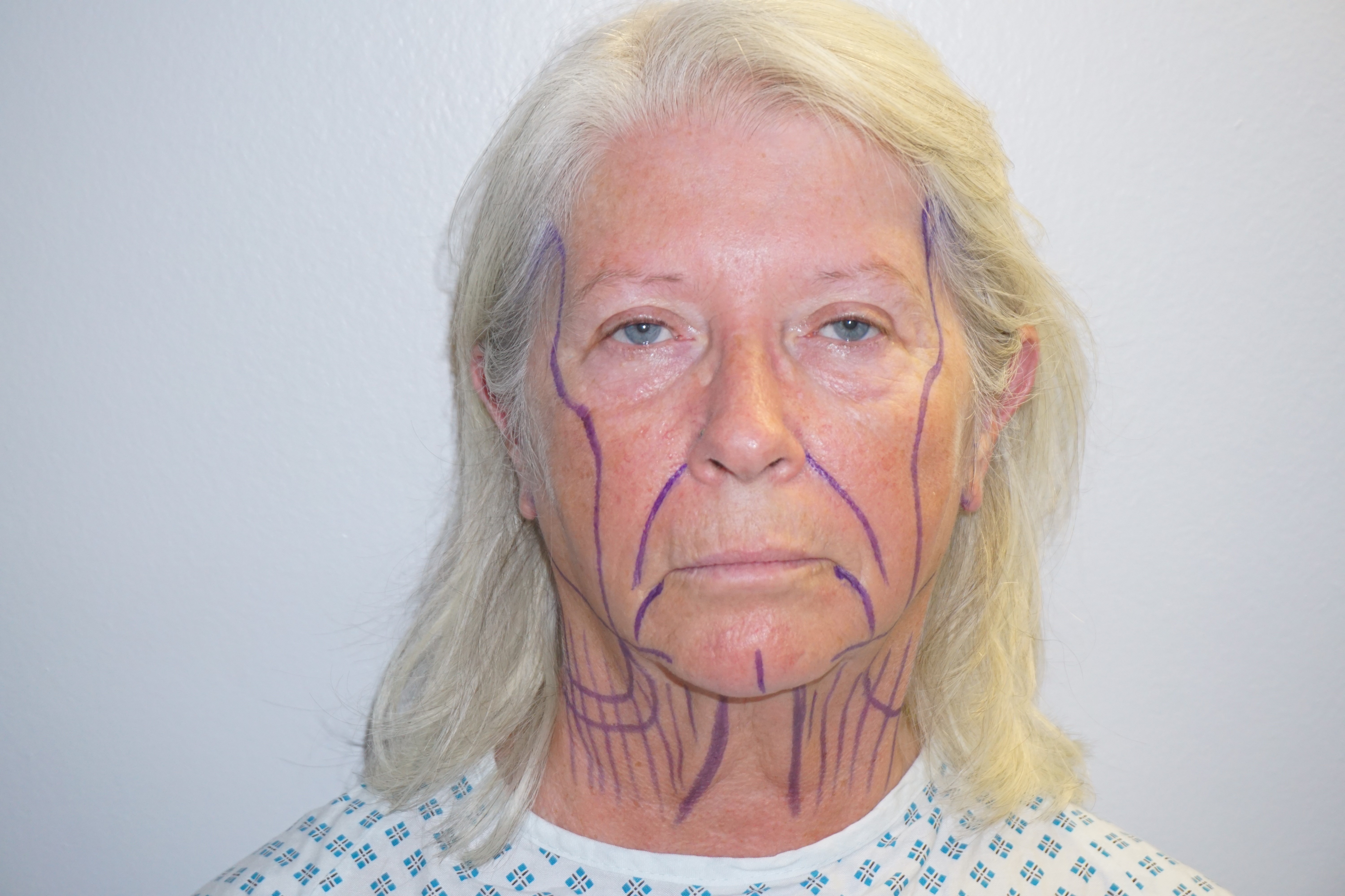 Natural Looks Pre Op1.jpg