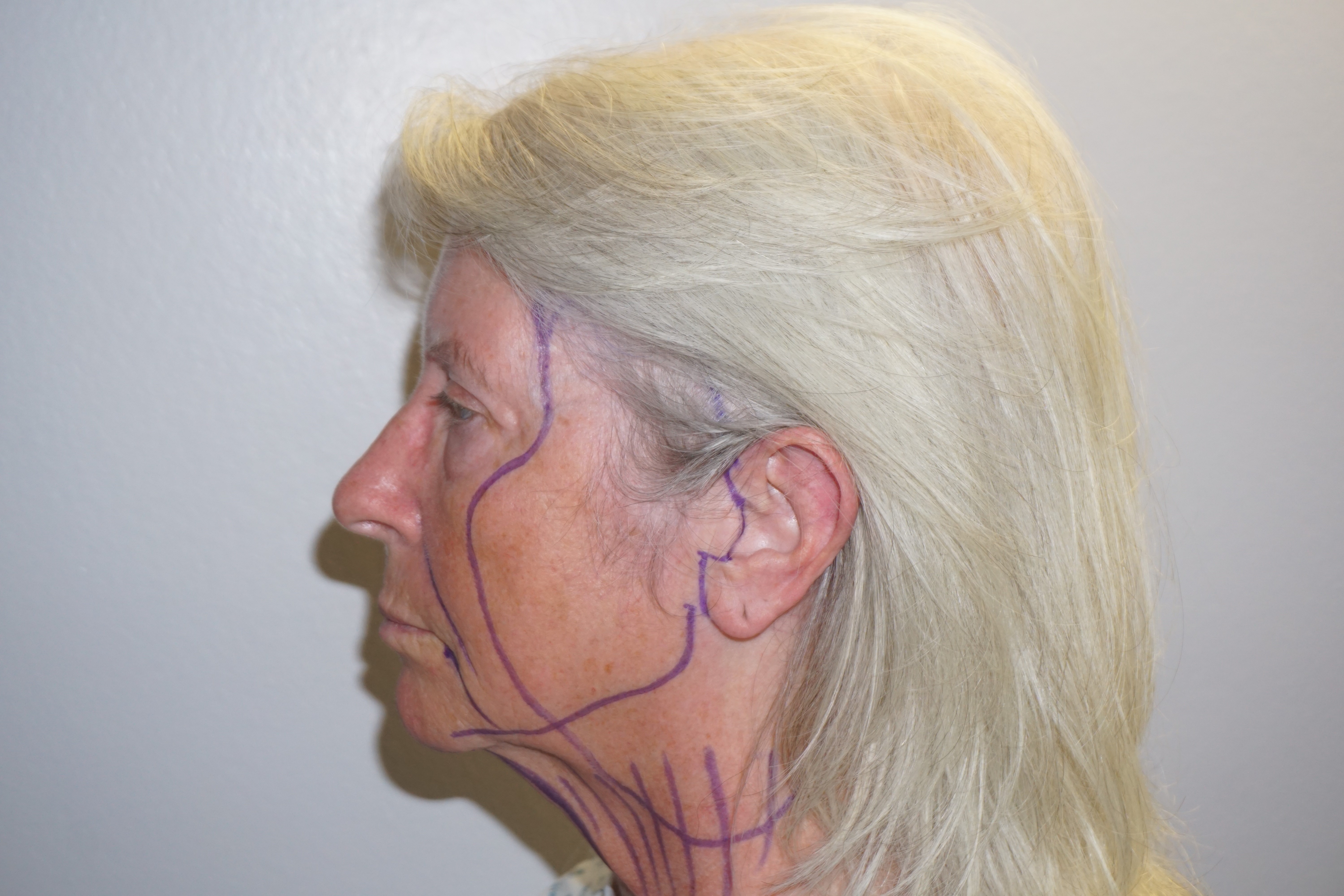 Natural Looks Pre Op2.jpg