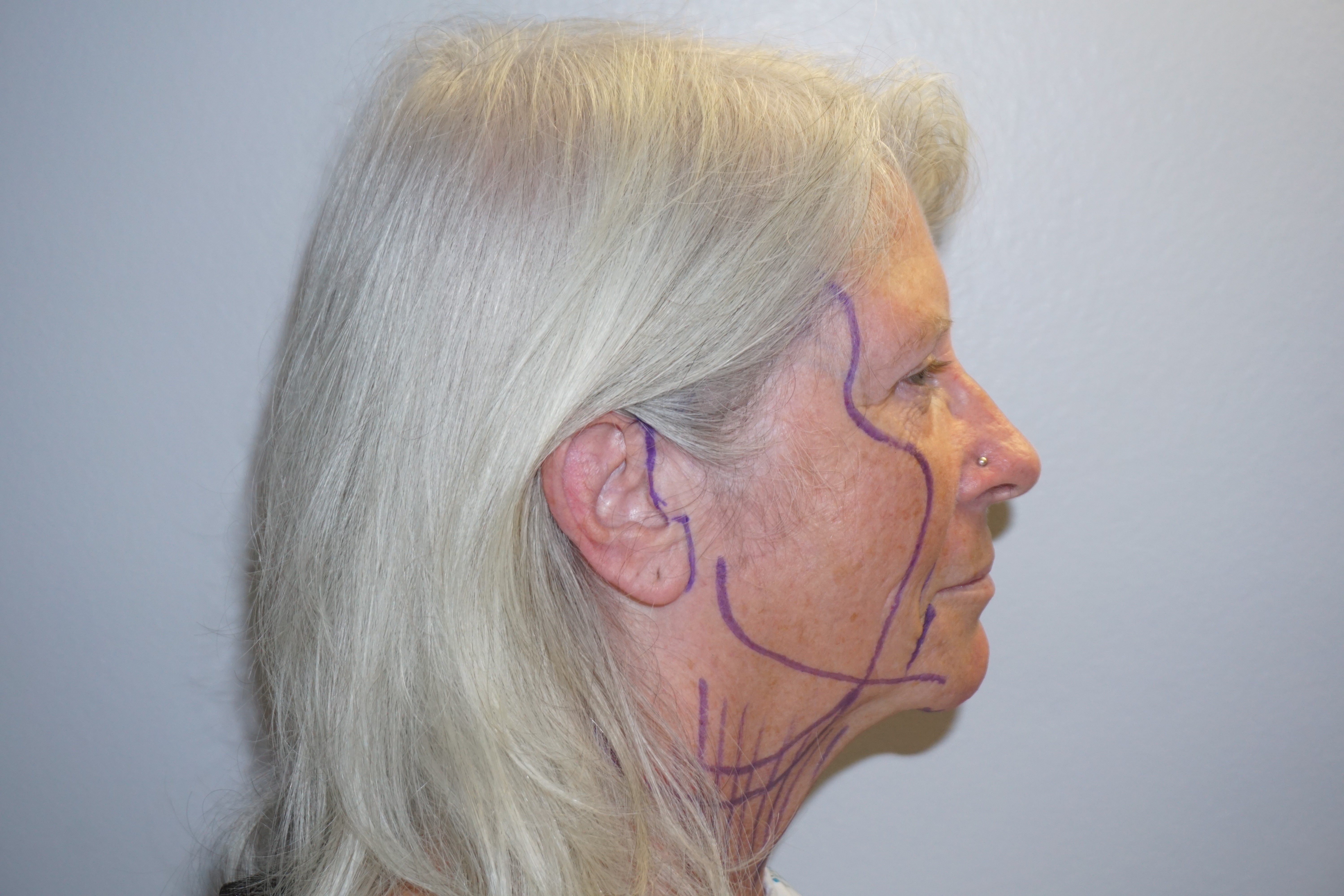 Natural Looks Pre Op3.jpg