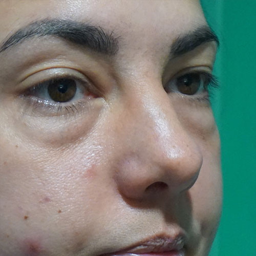 Pre-Lower-Eyelid-Blepharoplasty-3.jpg