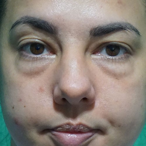 Pre-Lower-Eyelid-Blepharoplasty-1.jpg