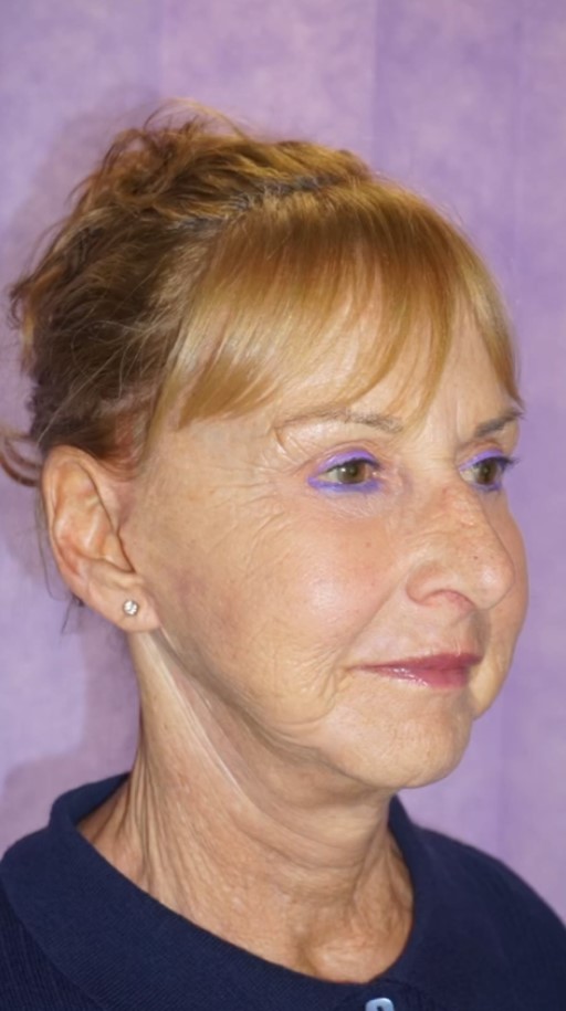 Facelift Post 2.jpg