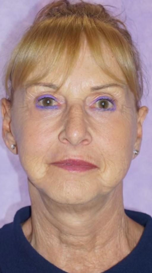 Facelift Post 4.jpg
