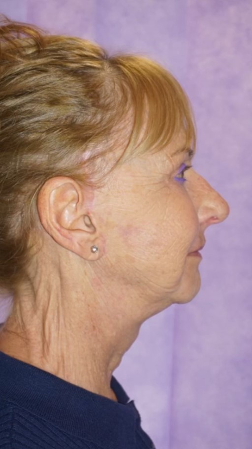 Facelift Post 1.jpg