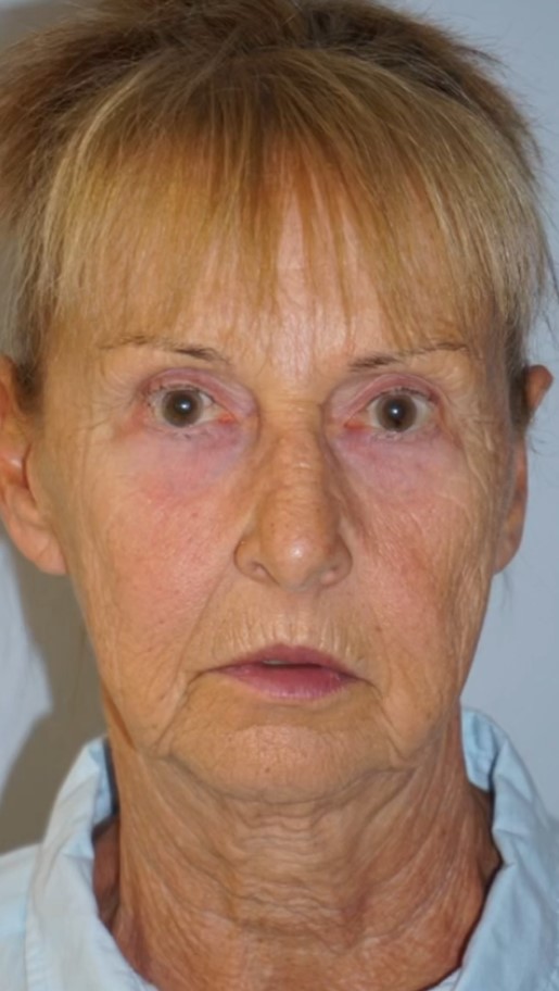 Facelift Pre 4.jpg