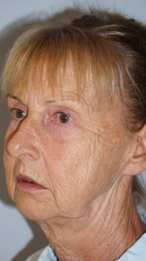 Facelift Pre 5.jpg