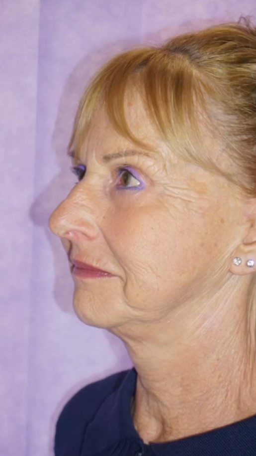 Facelift Post 5.jpg