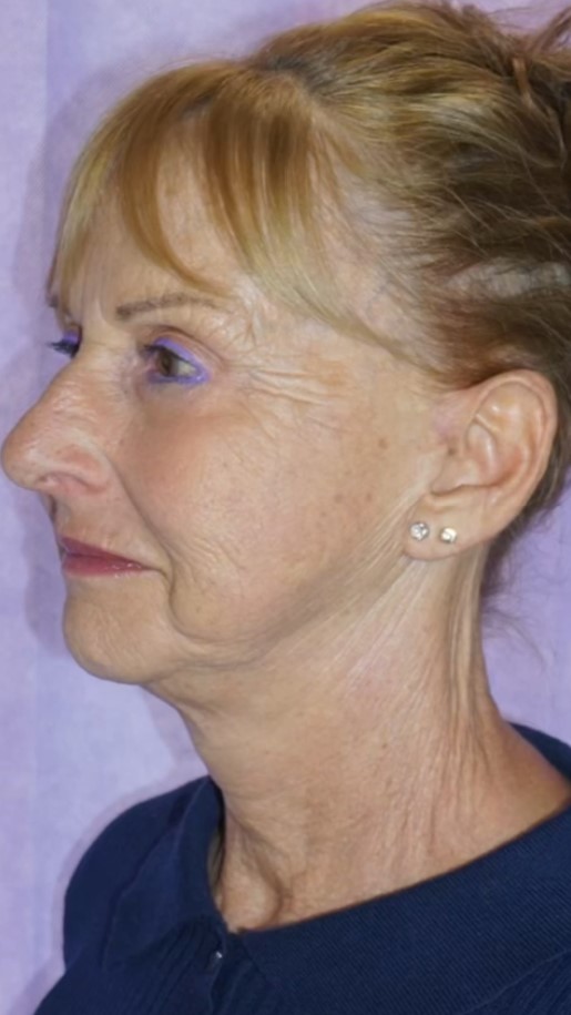 Facelift Post 6.jpg