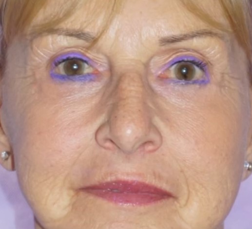 Facelift Post 7.jpg