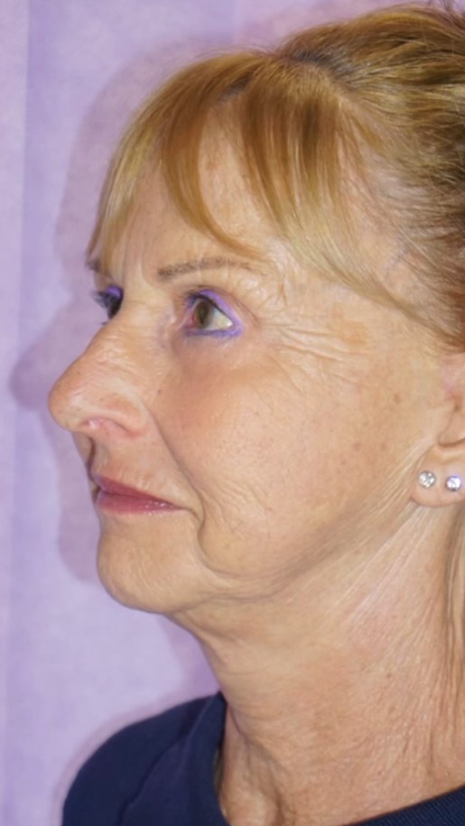 Facelift Post 8.jpg